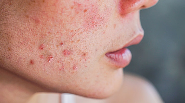 mulher de pele clara com lesões de acne na face